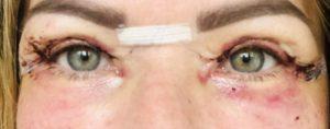 Appearances 5 days after upper blepharoplasty eyelid surgery Photos showing appearances 5 days after upper blepharoplasty eyelid surgery