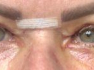 Photos showing appearances 6 days after upper blepharoplasty eyelid surgery