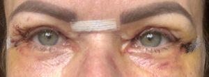 Appearances 6 days after upper blepharoplasty eyelid surgery Photos showing appearances 6 days after upper blepharoplasty eyelid surgery