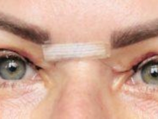 Photos showing appearances 7 days after upper blepharoplasty eyelid surgery