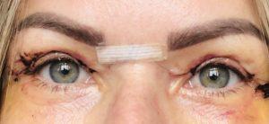 Appearances 7 days after upper blepharoplasty eyelid surgery Photos showing appearances 7 days after upper blepharoplasty eyelid surgery