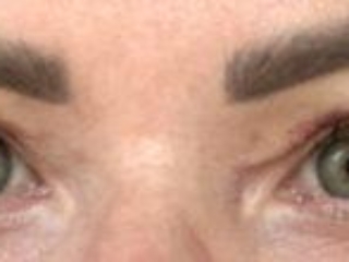Photos appearances 2 weeks after upper blepharoplasty eyelid surgery