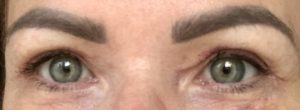 Appearances 2 weeks after upper blepharoplasty eyelid surgery Photos appearances 2 weeks after upper blepharoplasty eyelid surgery