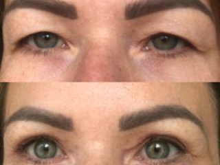 Appearances before and after upper eyelid blepharoplasty surgery