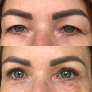 Appearances before and after upper eyelid blepharoplasty surgery Appearances before and after upper eyelid blepharoplasty surgery