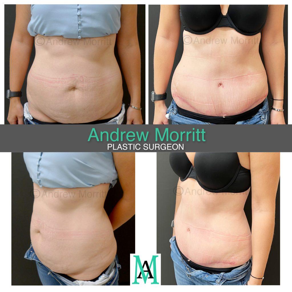 appearances before and after tummy tuck