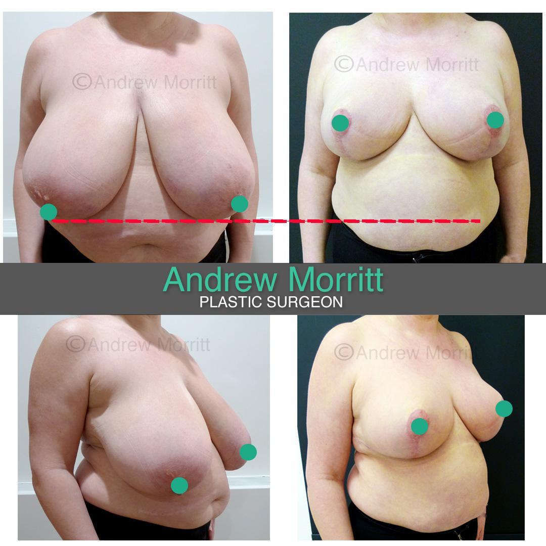 breast reduction