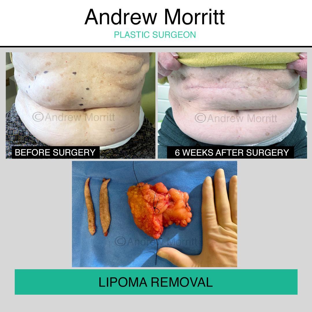 photos showing appearances before and after large lipoma (fat lump) removal sheffield