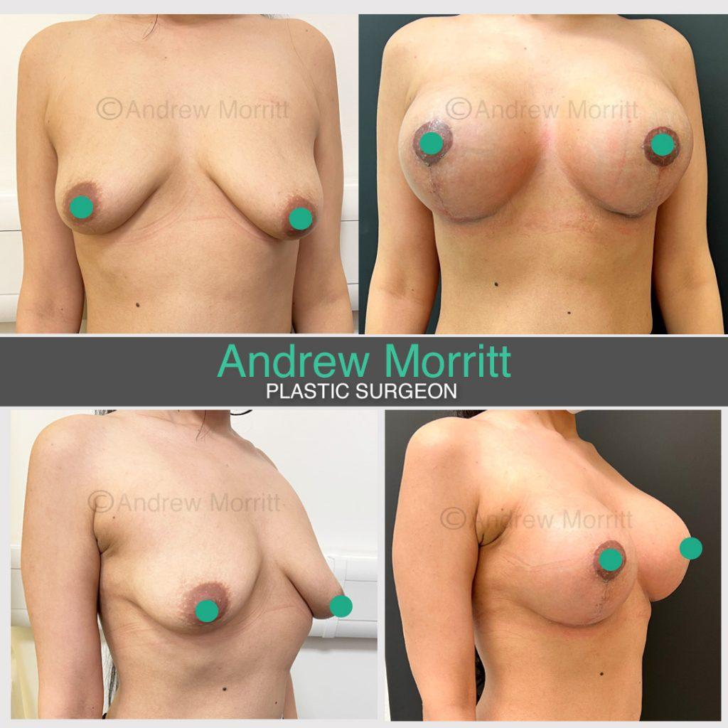 photos before after breast augmentation mastopexy uplift sheffield round implants
