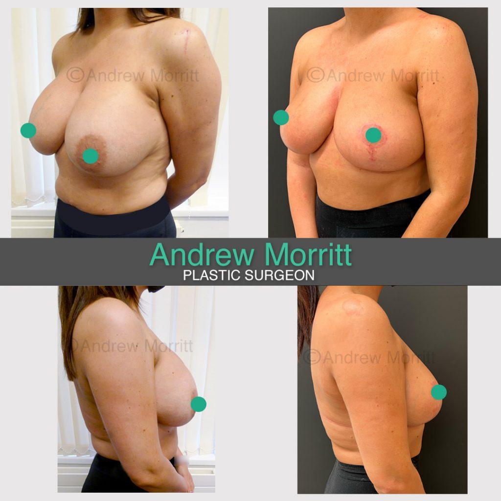 breast implant removal capsulectomy and uplift with auto augmentation