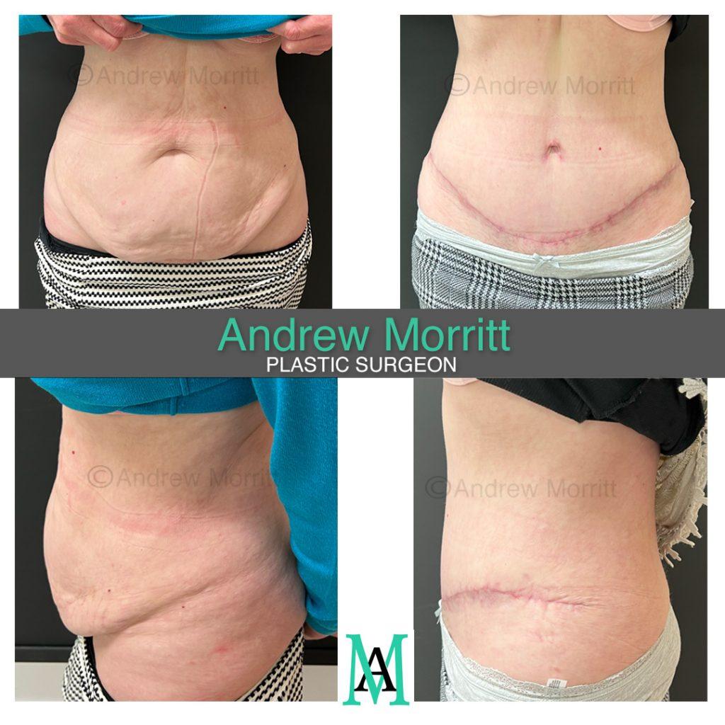 appearances before and after tummy tuck