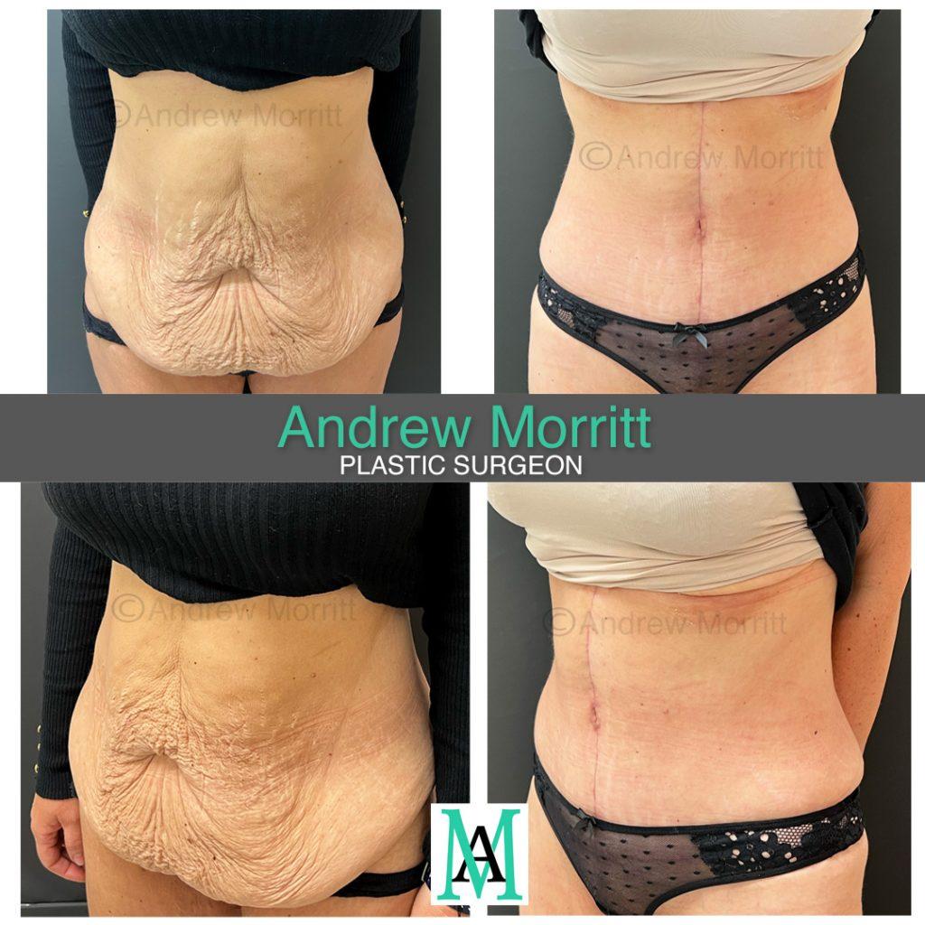 fleur de lys abdominoplasty tummy tuck