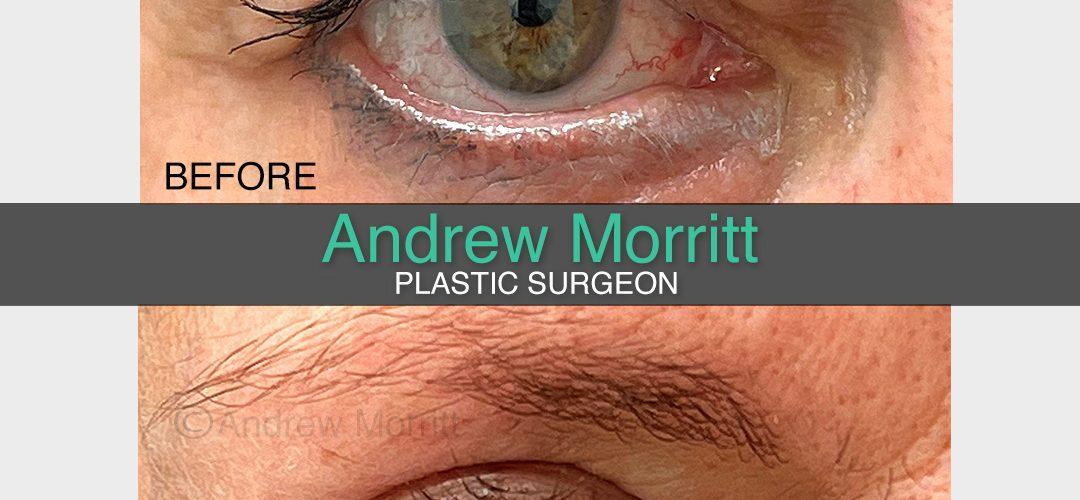 photos showing appearance before and after upper eyelid skin excision blepharoplasty lift