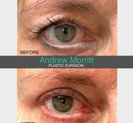 photos showing appearance before and after upper eyelid skin excision blepharoplasty lift