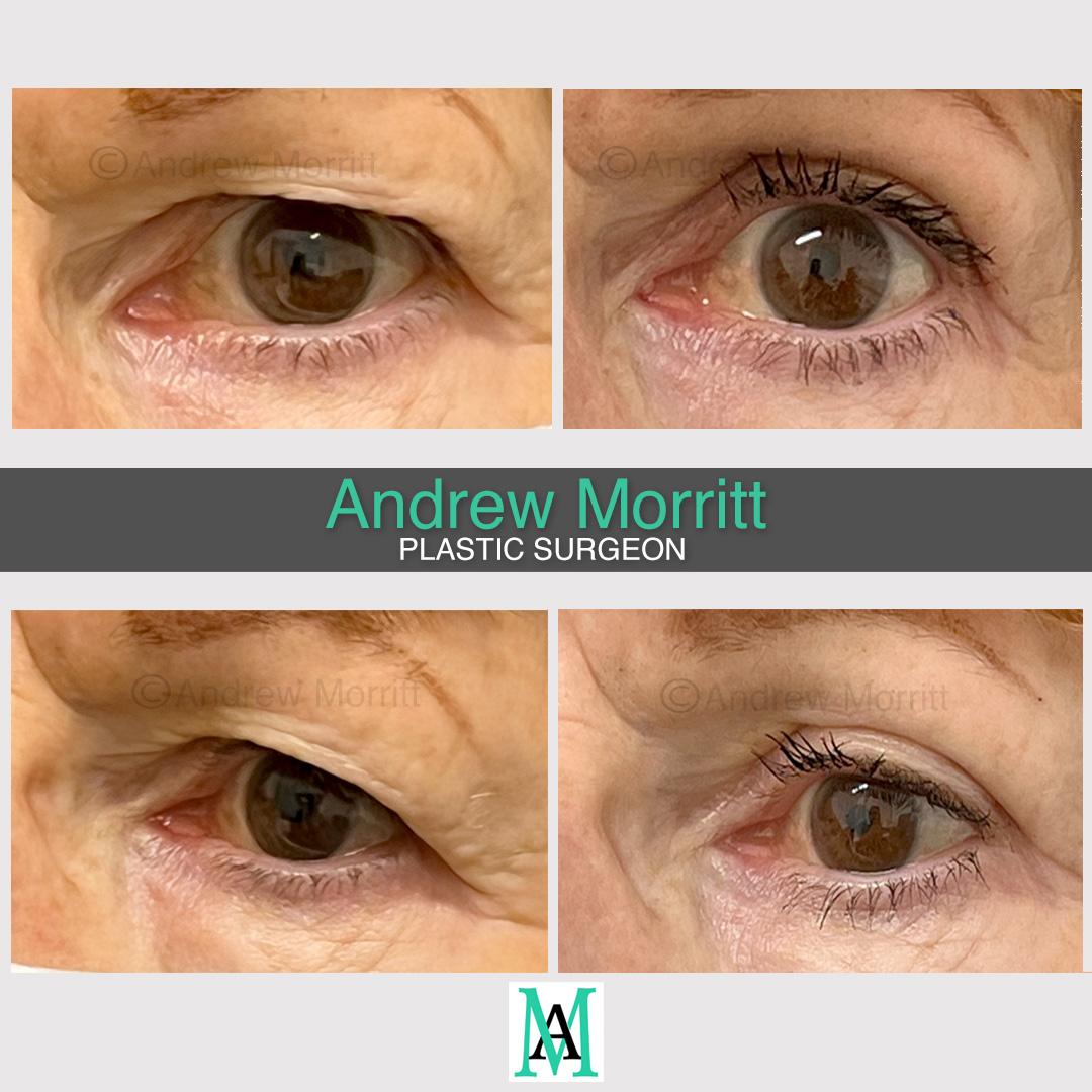 photos upper eyelid skin excision blepharoplasty sheffield