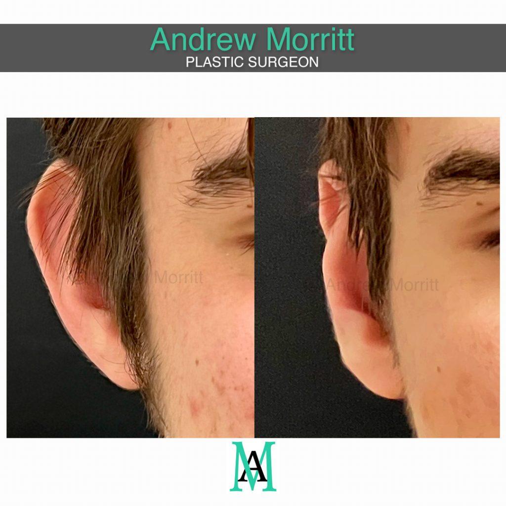 photos showing appearances before and after prominent ear correction surgery otoplasty ear pinning sheffield