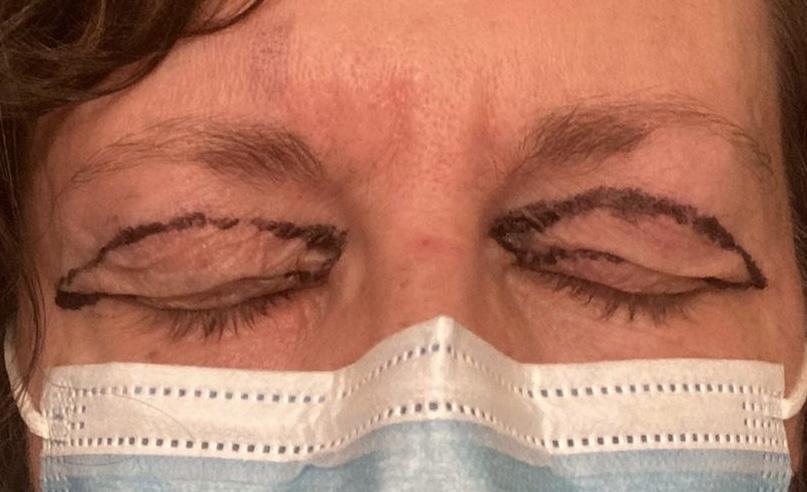 photos showing markings before upper blepharoplasty eyelid lift sheffield 