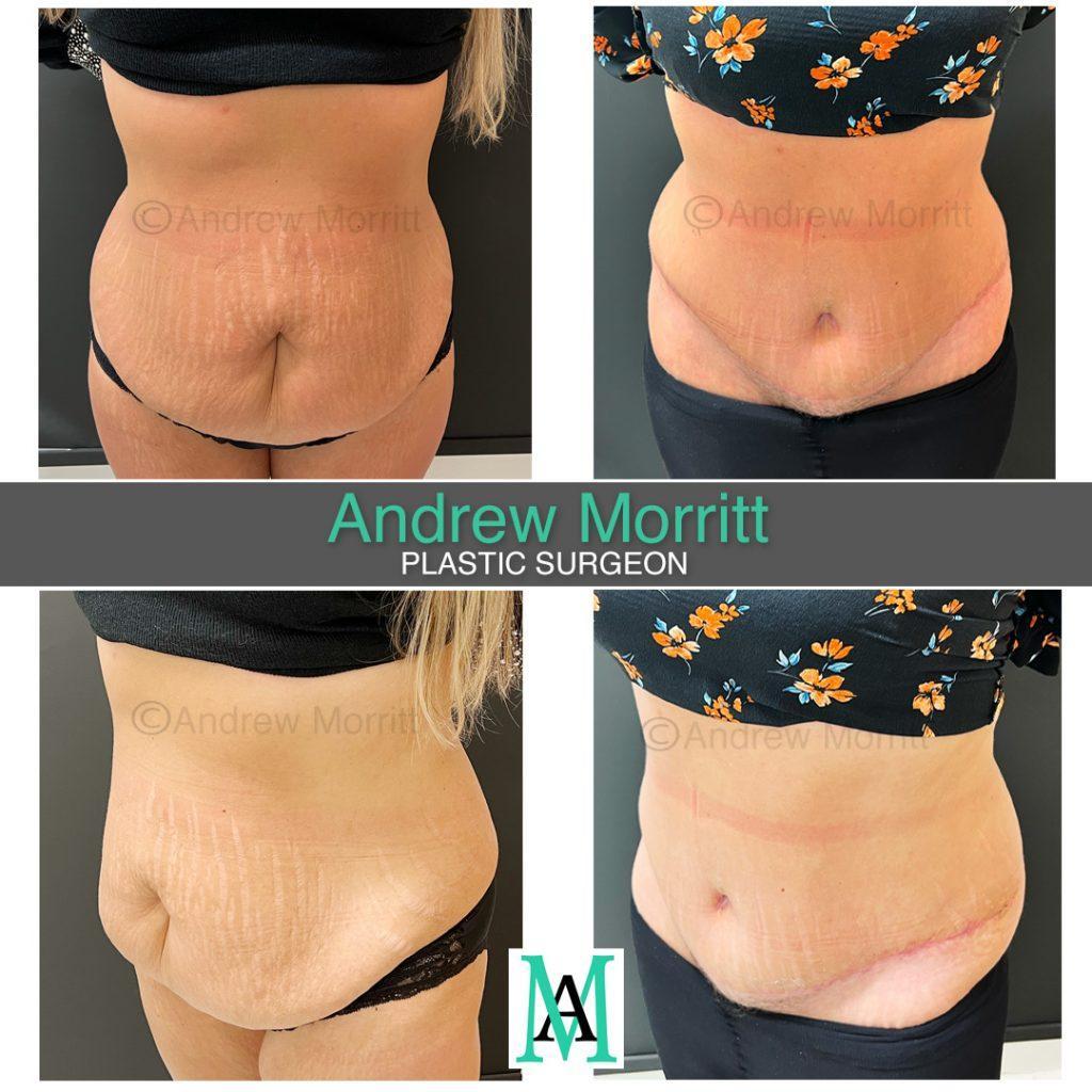 appearances before and after tummy tuck