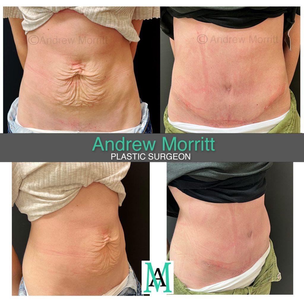 appearances before and after tummy tuck