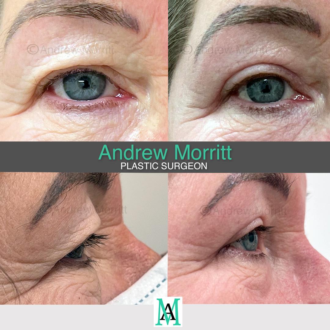 photos showing appearances before and after upper eyelid skin excision blepharoplasty sheffield eyelid lift