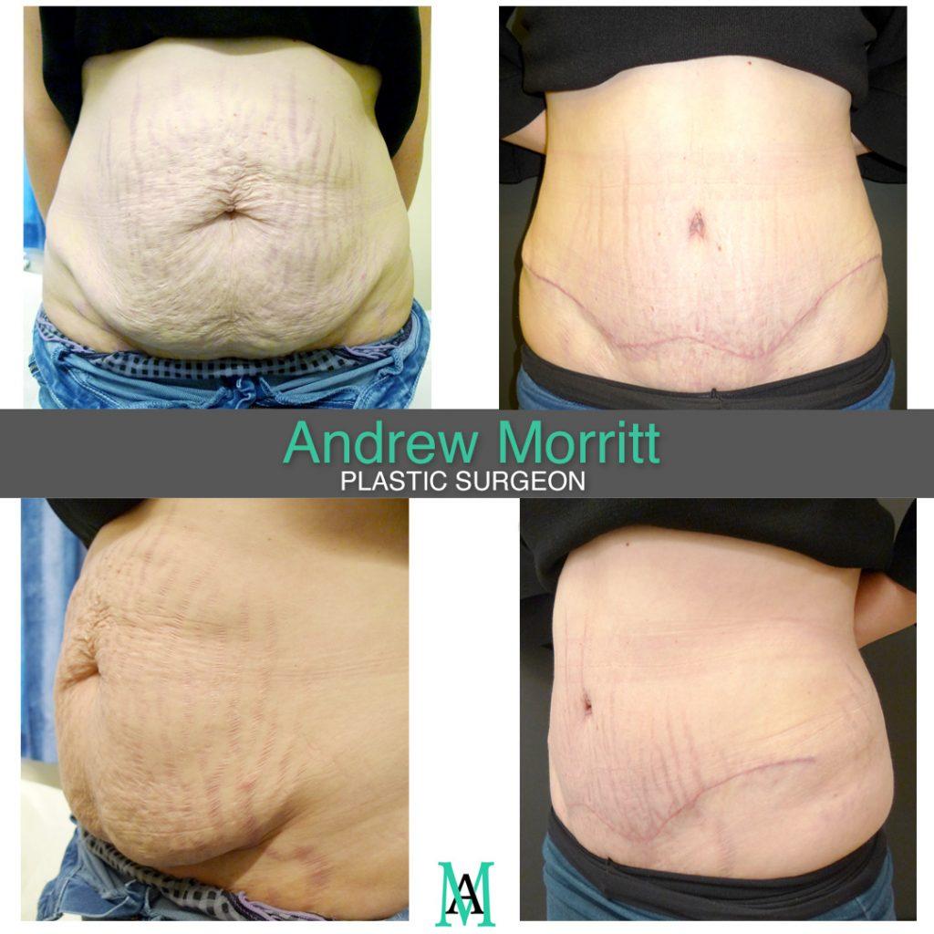 appearances before and after tummy tuck surgery