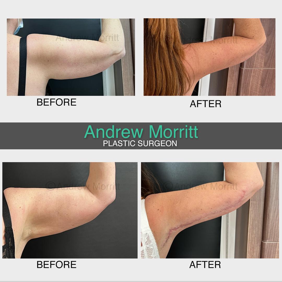 photos before and after arm reduction lift surgery sheffield