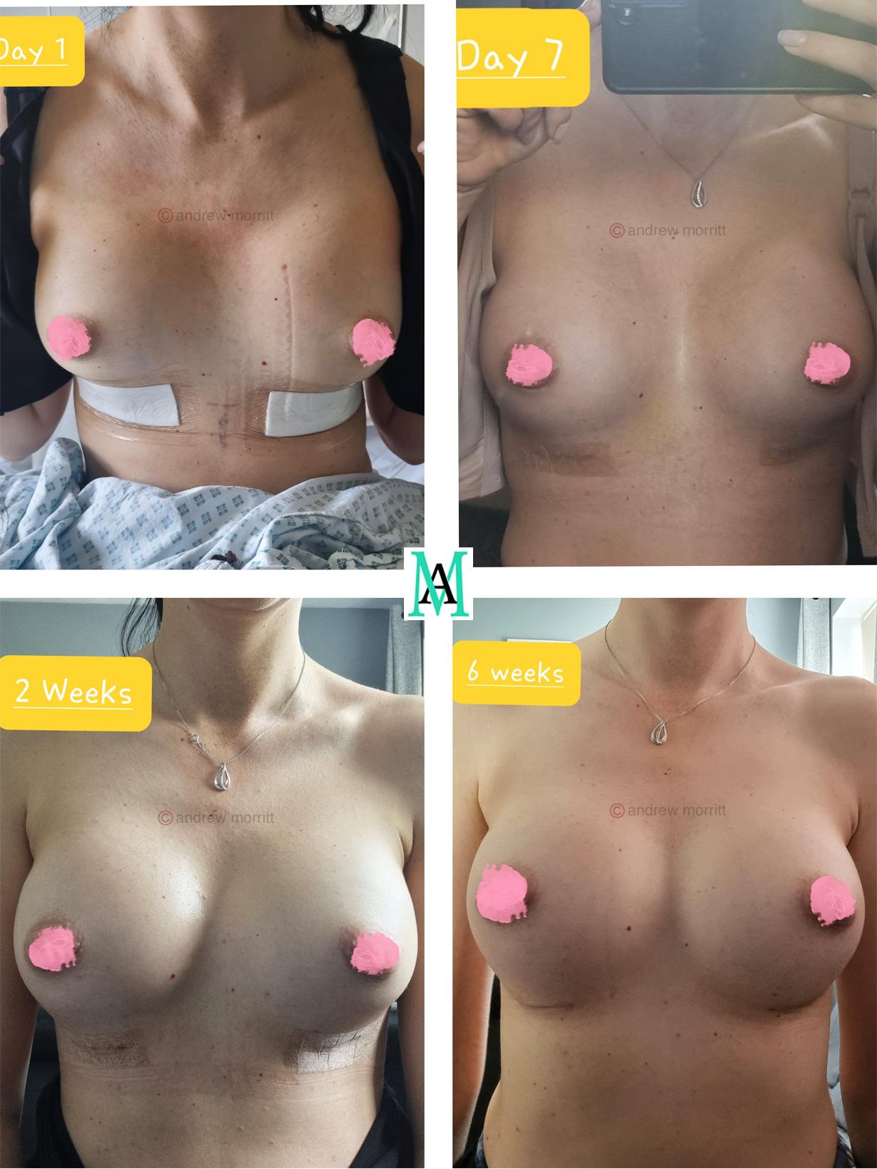 photos showing healing after breast augmentation