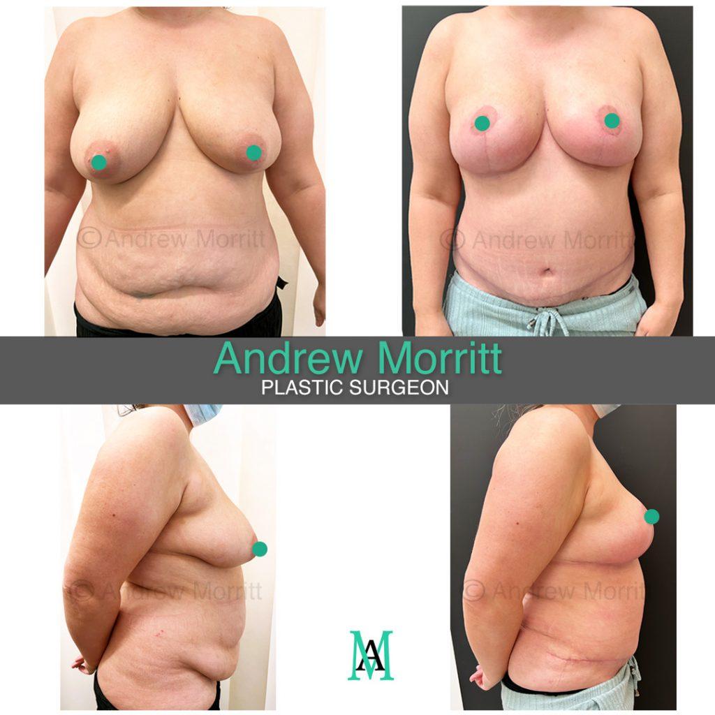 Mummy makeover sheffield