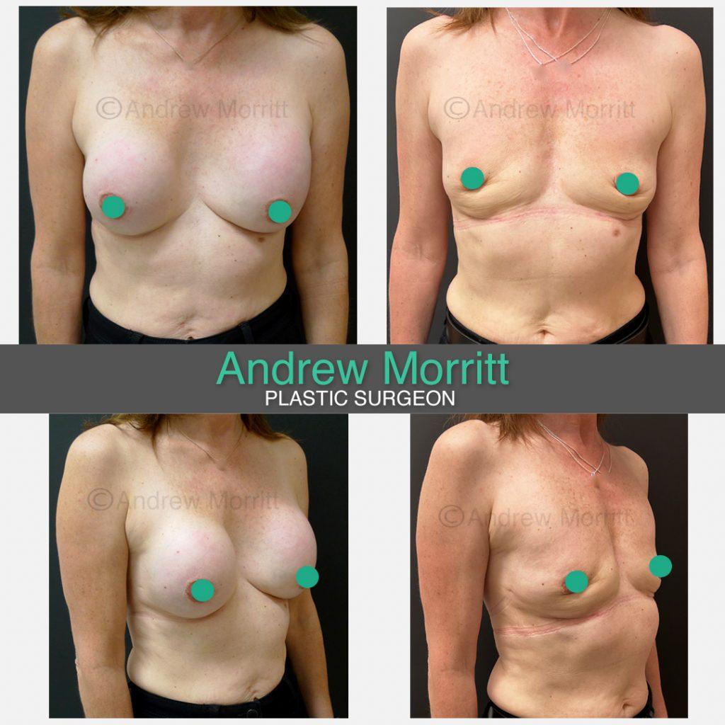 photos showing appearances before and 6 months after removal of breast implants sheffield