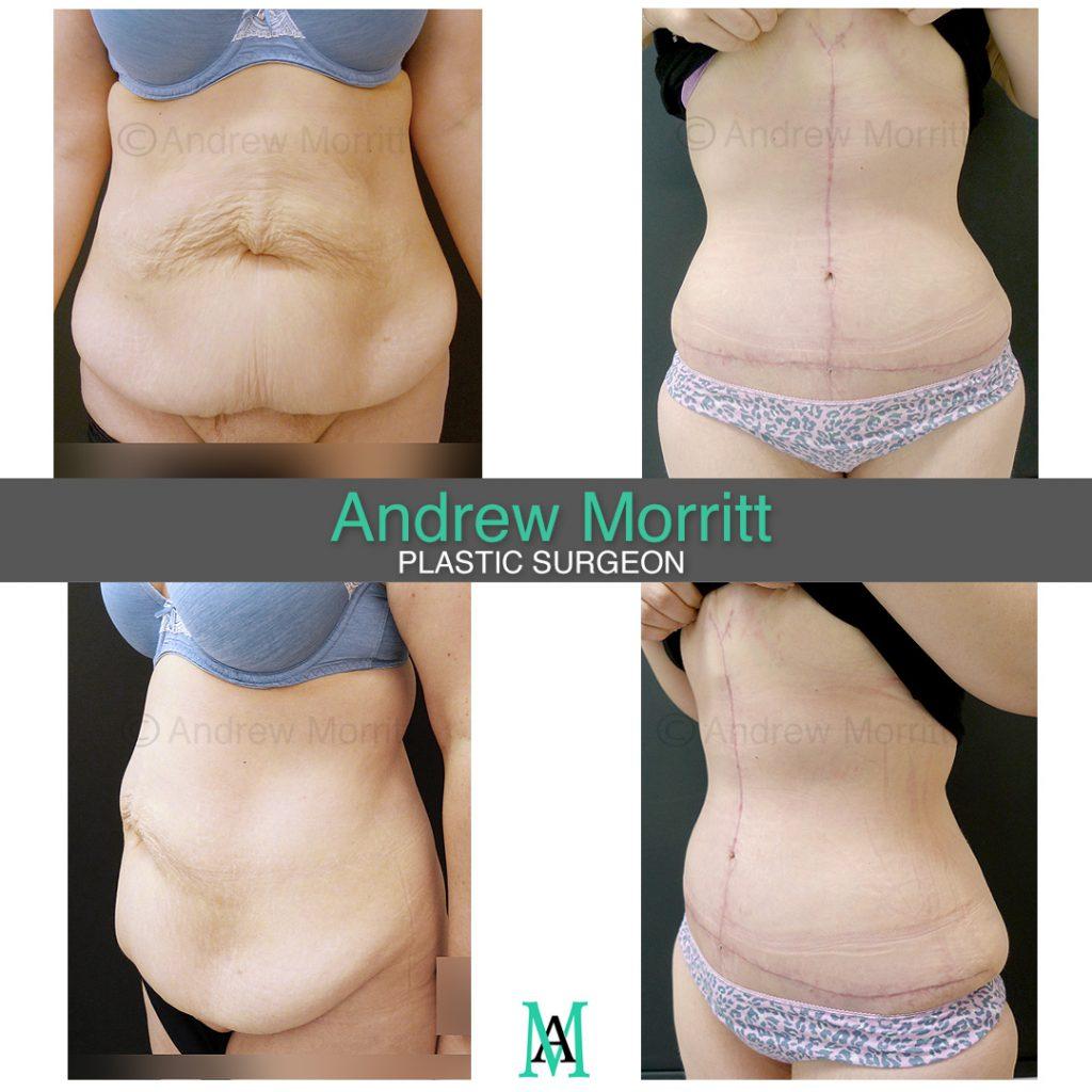 appearances before and after fleur de lys tummy tuck and mons reduction