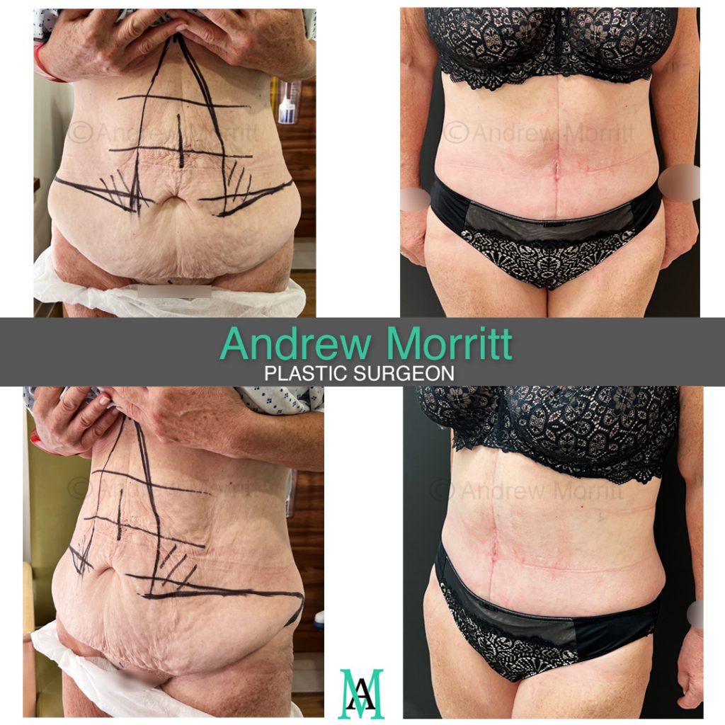 fleur de lys abdominoplasty tummy tuck