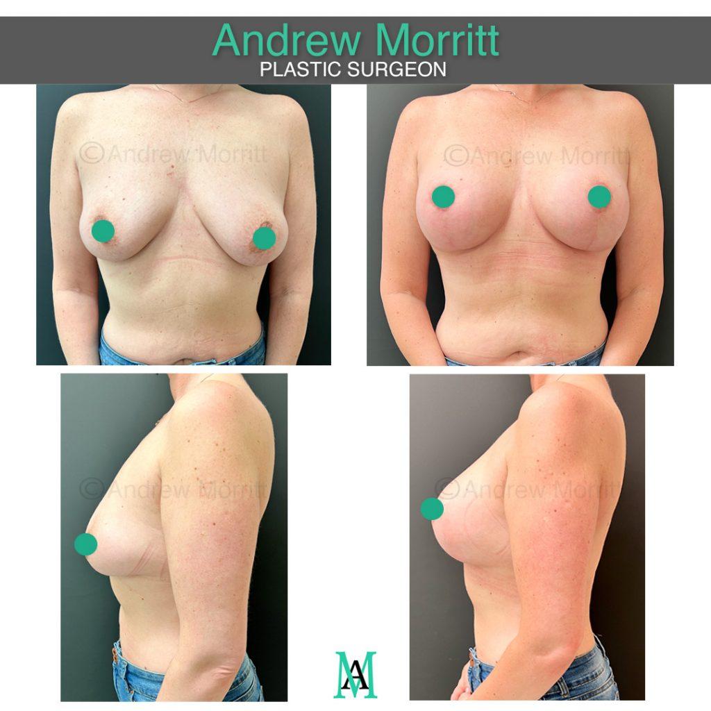 photos showing appearances before and after breast augmentation enlargement implants and uplift mastopexy sheffield