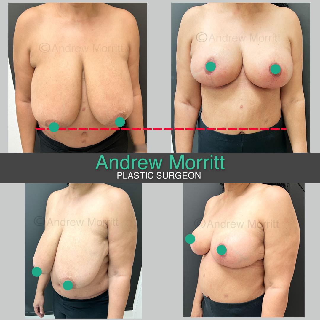 breast reduction dark skin