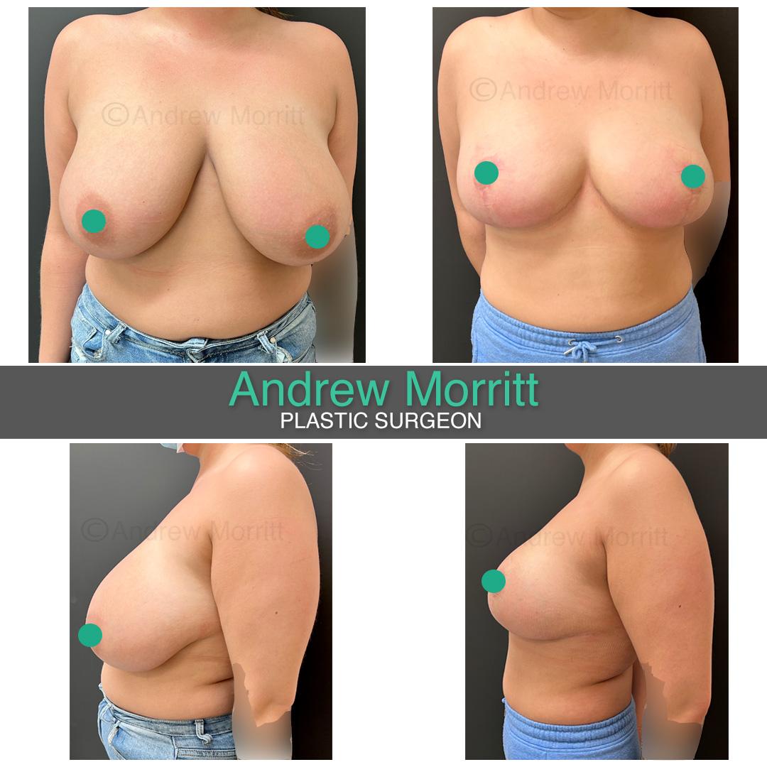 breast reduction