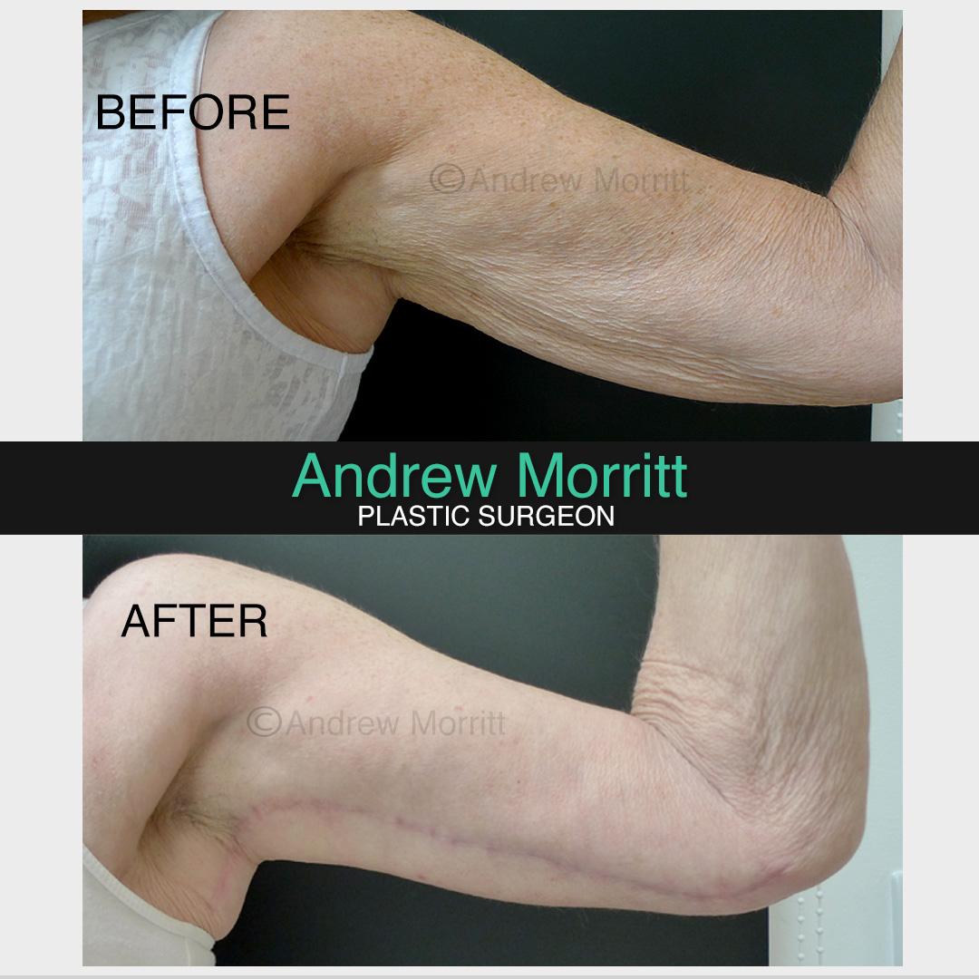 arm reduction surgery sheffield