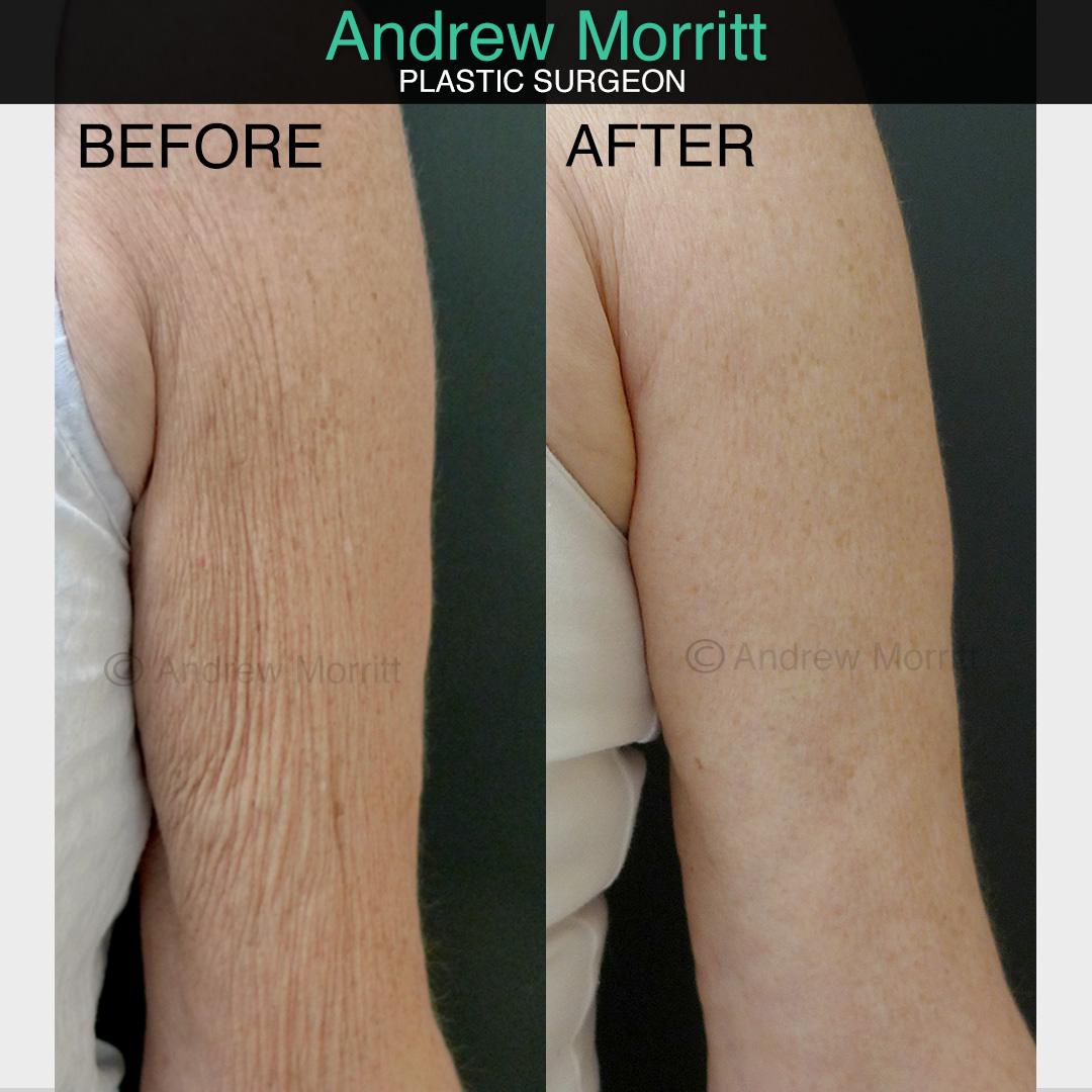 arm reduction surgery sheffield