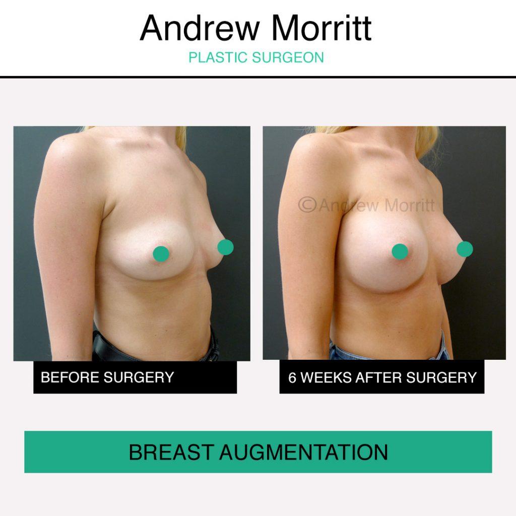 breast augmentation enlargement sheffield 2 breast augmentation enlargement sheffield