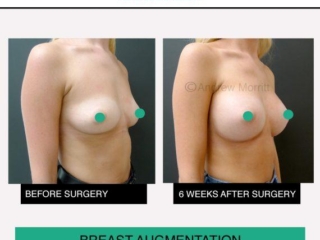 breast augmentation enlargement sheffield 2 breast augmentation enlargement sheffield