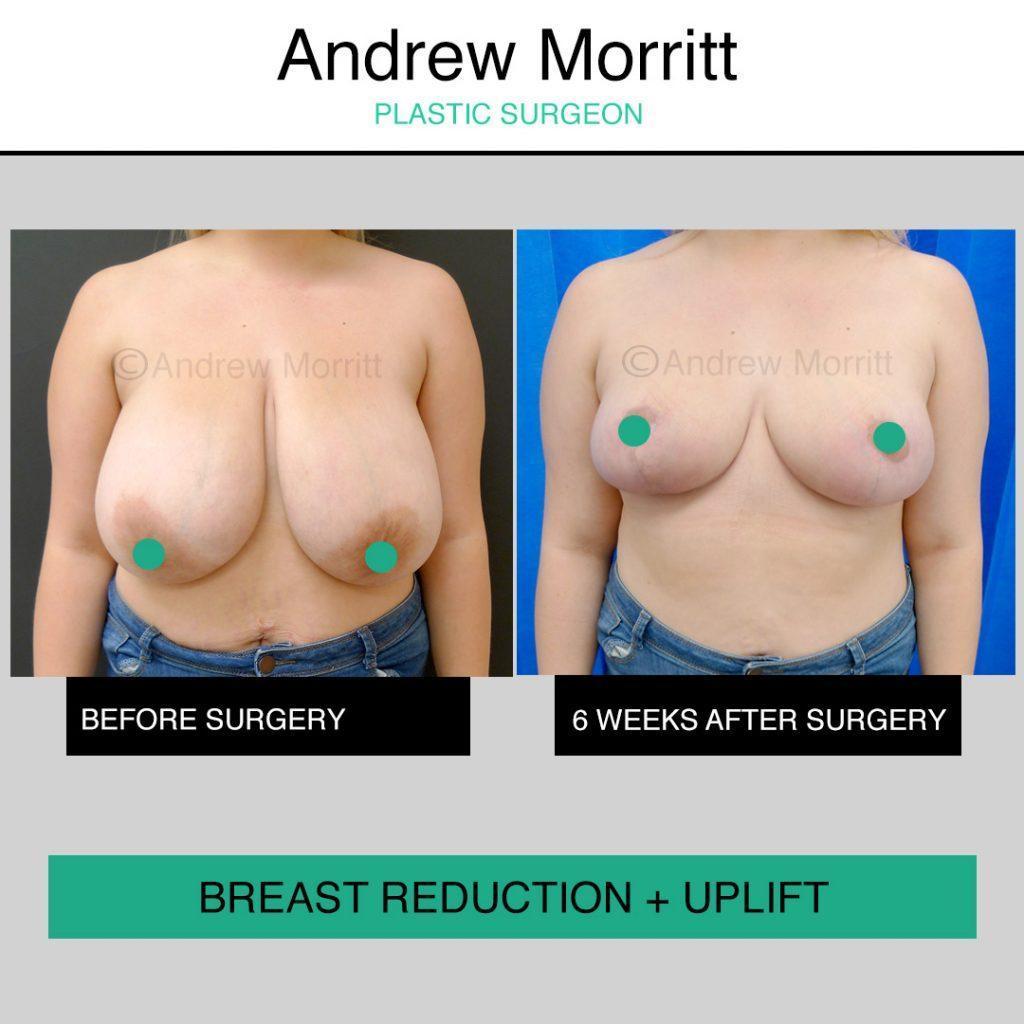 Breast reduction Breast reduction