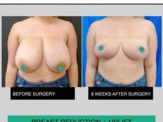 Breast reduction