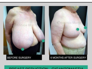 Breast reduction