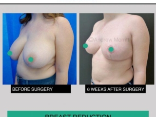 Breast reduction