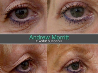 Upper blepharoplasty eyelid surgery Sheffield