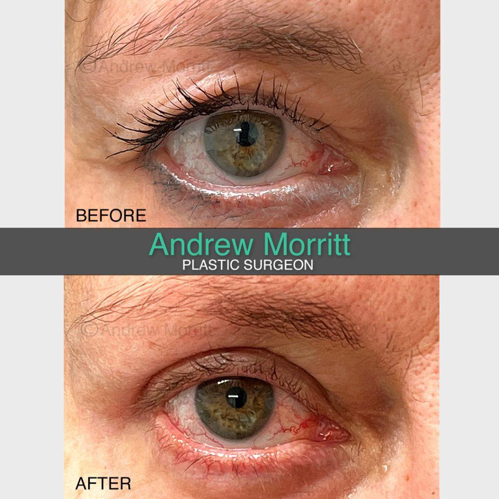 Upper blepharoplasty Upper blepharoplasty eyelid surgery Sheffield