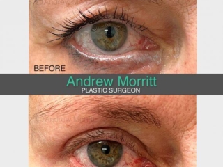 Upper blepharoplasty eyelid surgery Sheffield