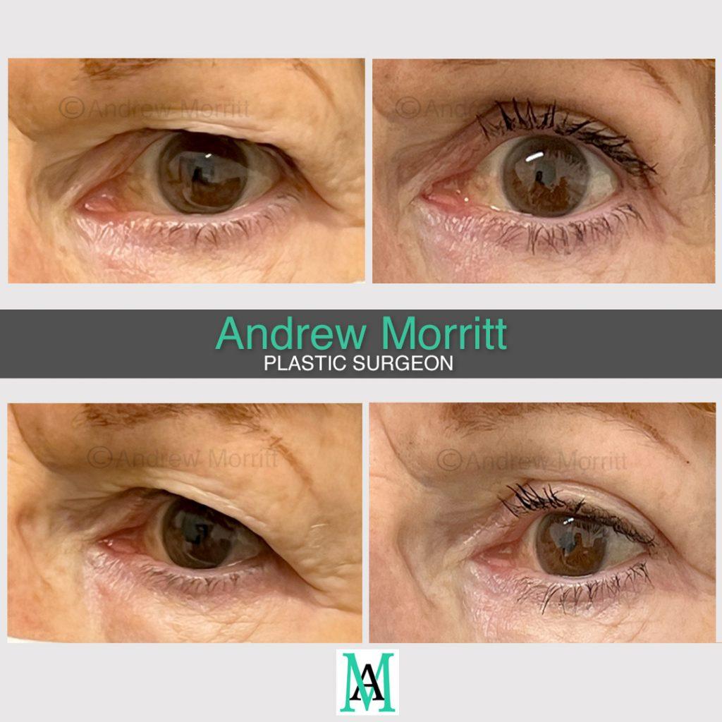 Upper blepharoplasty Upper blepharoplasty eyelid surgery Sheffield