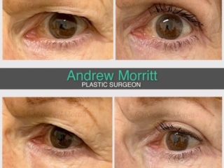 Upper blepharoplasty eyelid surgery Sheffield