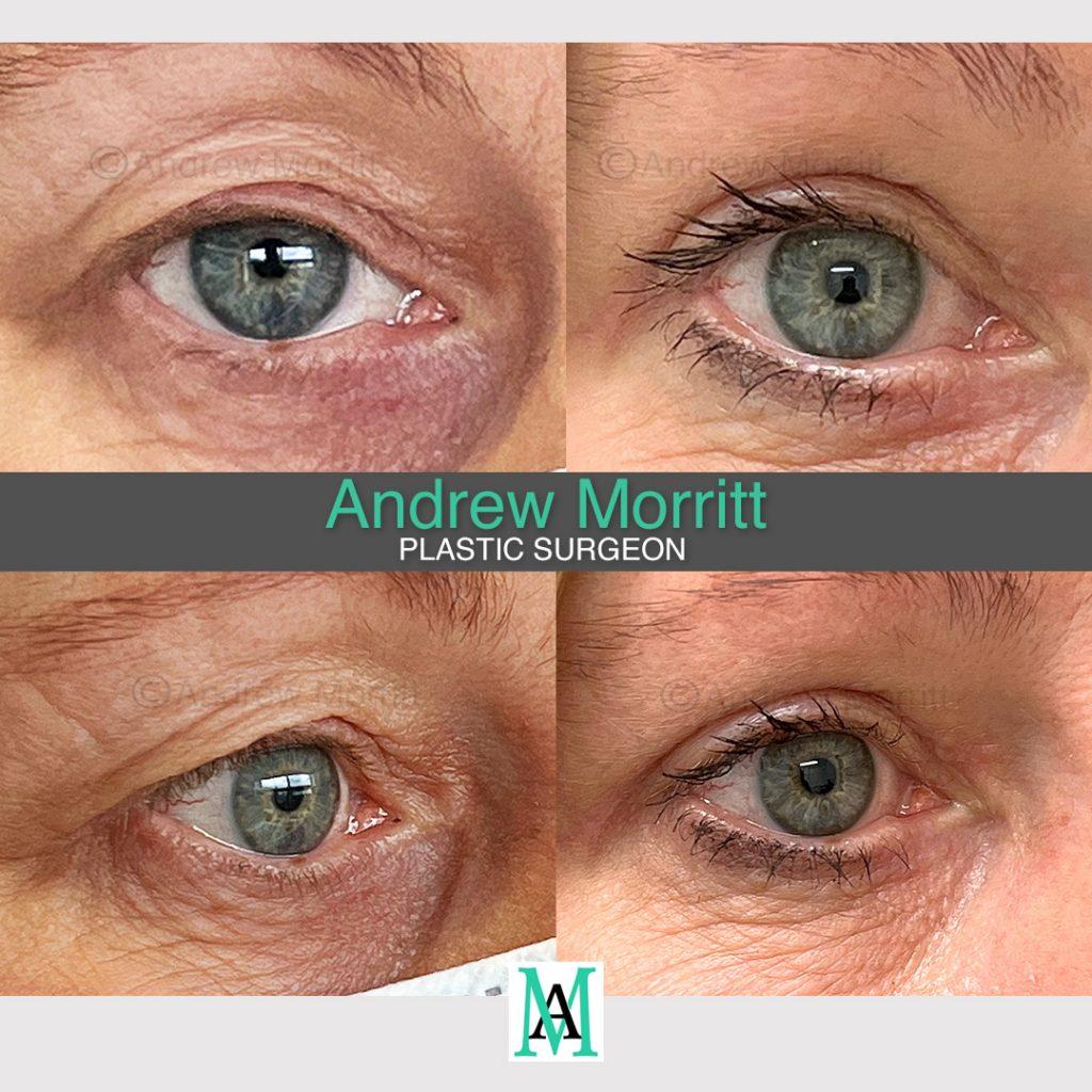 Upper blepharoplasty Upper blepharoplasty eyelid surgery Sheffield