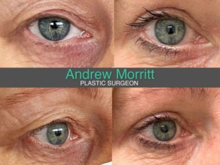 Upper blepharoplasty eyelid surgery Sheffield