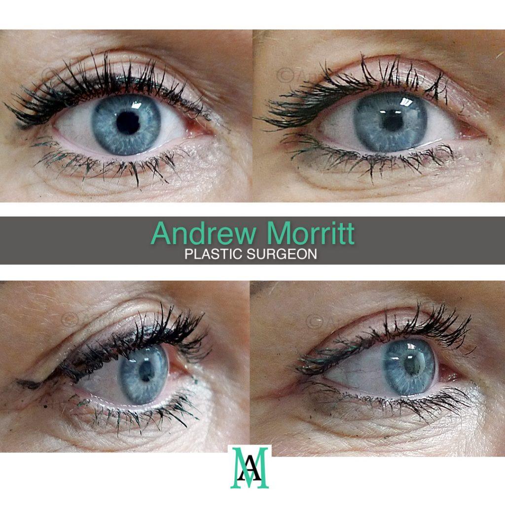 Upper blepharoplasty Upper blepharoplasty eyelid surgery Sheffield